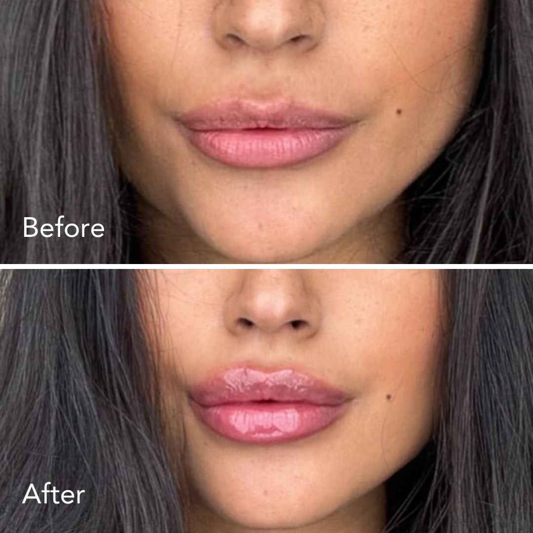 Lip Plumper ( 1+1 gratis)